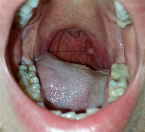 Is This Throat Cancer Images Cancer Forums Patient