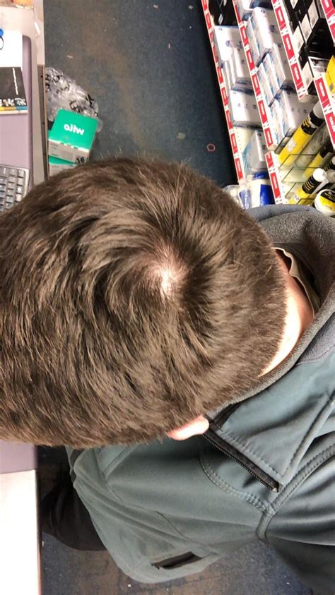 Normal Or Going Crown Hairloss
