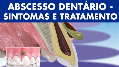 Abscesso Dentário Sintomas De Abcesso No Dente E Tratamento © Youtube