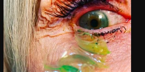 Video Doctor Removes 23 Contact Lenses From Patients Eye The Current