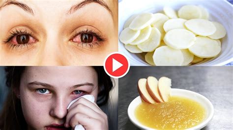 Relieve Pink Eye With 5 Natural Remedies How To Get Rid Of Pink Eye