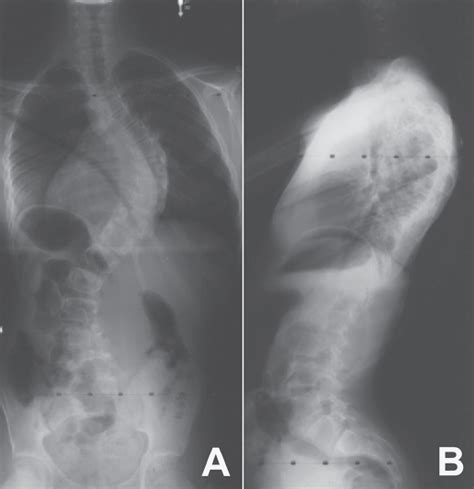 Adolescent Idiopathic Scoliosis Musculoskeletal Key
