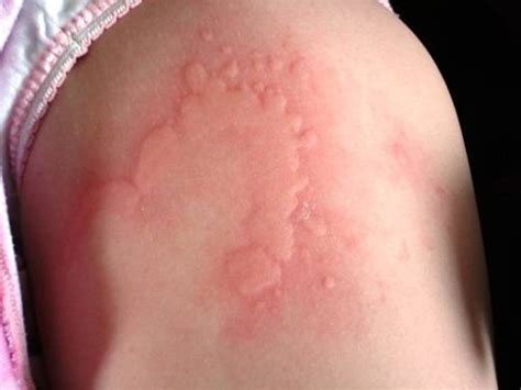 Treatment Of Common Allergic Reactions Pm Press