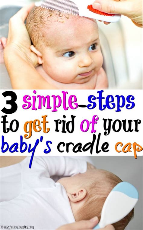 There are so many reasons that couples might have their eyes set on a twin pregnancy. 3 simple steps to get rid of your baby's cradle cap