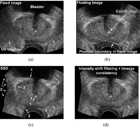 Figure 1 From Transrectal Ultrasound Prostate Biopsy Tracking With