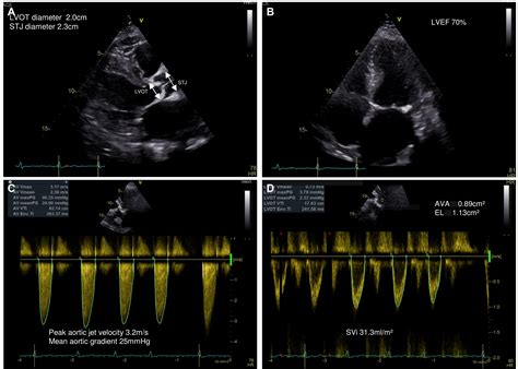 Aortic Valve Stenosis The Bergen Hypertension And Cardiac Dynamics