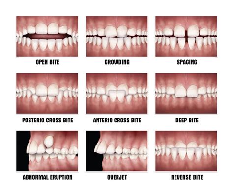 Summary Of Patients With Icr Sex Type Of Malocclusion Tmd Hot Sex Picture