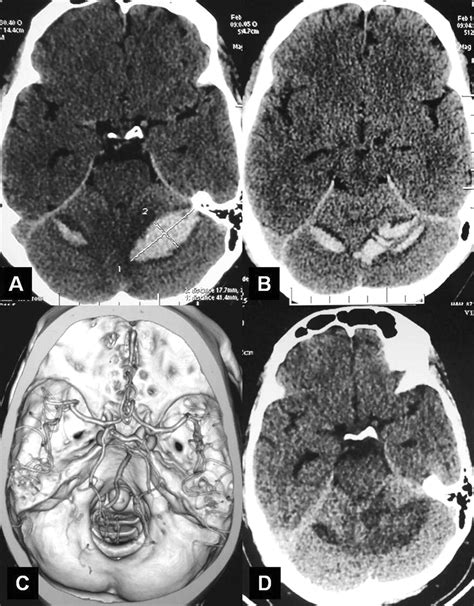 Conservative Management In A Rare Case Of Spontaneous Bilateral
