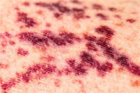 Skin Rashes A Clue To Covid 19 Vascular Disease Medpage Today