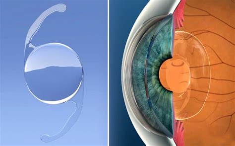 Laser Lens Replacement Replaces The Eyes Natural Lens With A High Performance Lens Implant