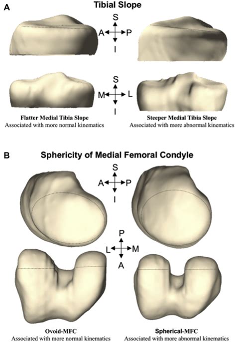 The Influence Of Tibial And Femoral Bone Morphology On Knee Kinematics
