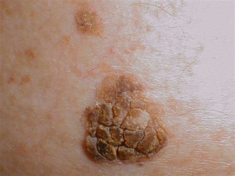 Dark Scaly Spots On Skin Skin Cancer Prevention Fraser Medical Clinic