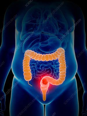 Illustration Of Colon Cancer Stock Image F Science Photo Library