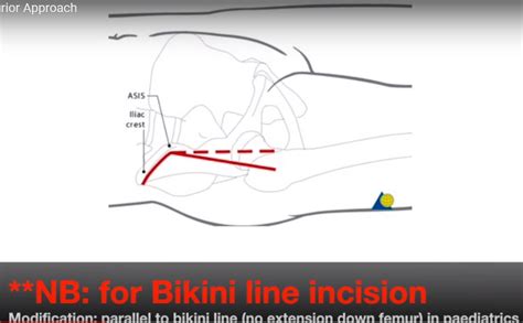 Anterior Approach To The Hip —