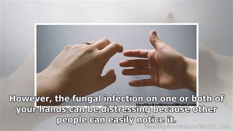 Hand Fungus Tinea Manuum Causes Symptoms And Natural Treatments Youtube
