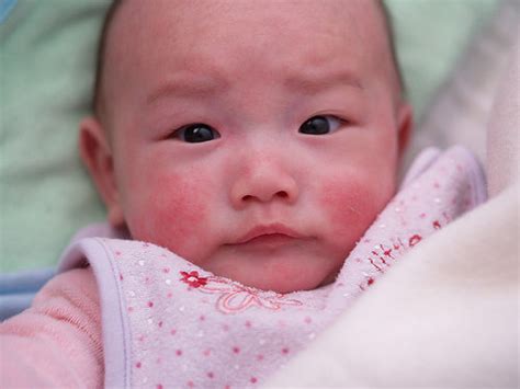 Cara tradisional untuk mengobati ruam pada tubuh bayi menggunakan manjakani. Risau Muka Bayi Selalu Naik Jerawat & Merah-merah, Ini 5 ...