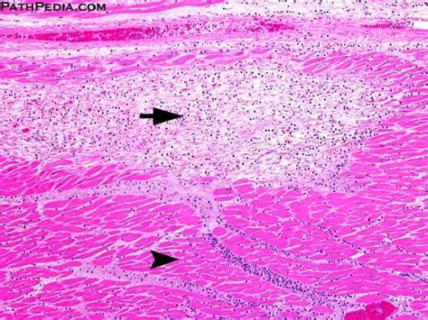 Acute myocarditis must be considered in patients who. Dating myocardial infarction histology