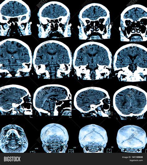 Mri Scan Human Brain Image And Photo Free Trial Bigstock