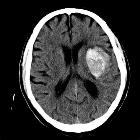 Hemorragia Intraparenquimatosa Intracerebral Ocronos Editorial