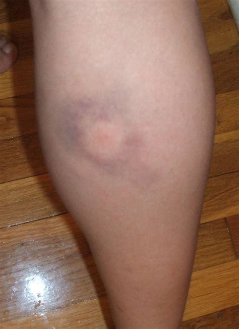 Bullseye Bruise From Spider Bite Real Inj Sim Mu Ref Pinterest