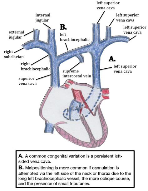 Central Venous Catheter Intravascular Malpositioning Causes