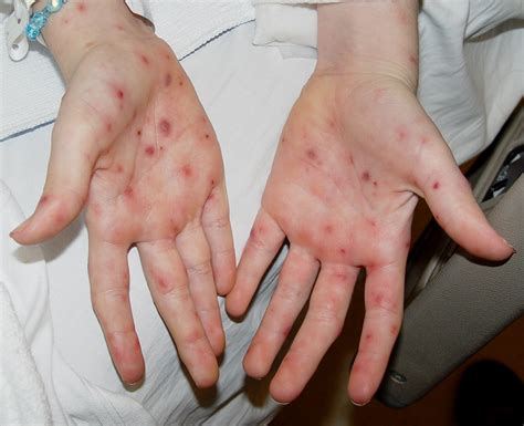 Rashes On Palms And Soles Pictures Photos