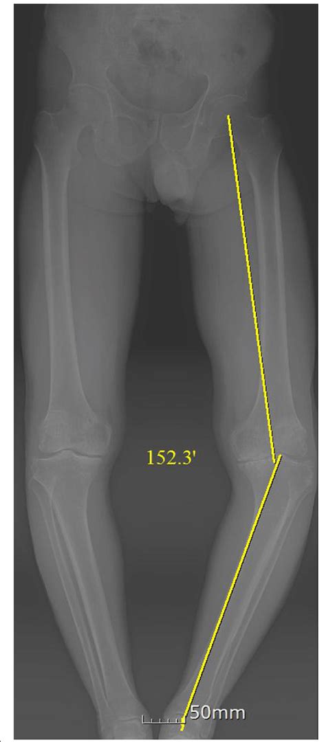 Preoperative Long Standing Anteroposterior Radiograph Of A Patient With Download Scientific