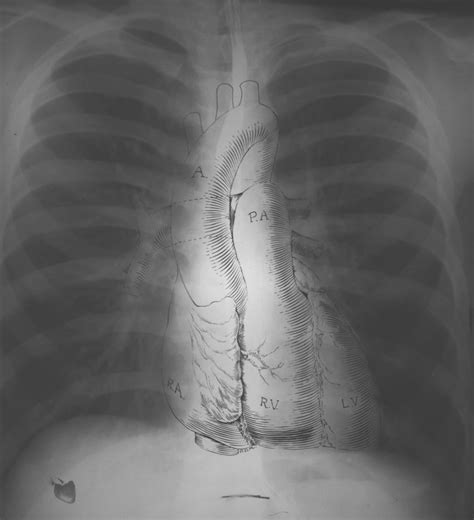 Normal Chest X Ray • Litfl Medical Blog • Labelled Radiology