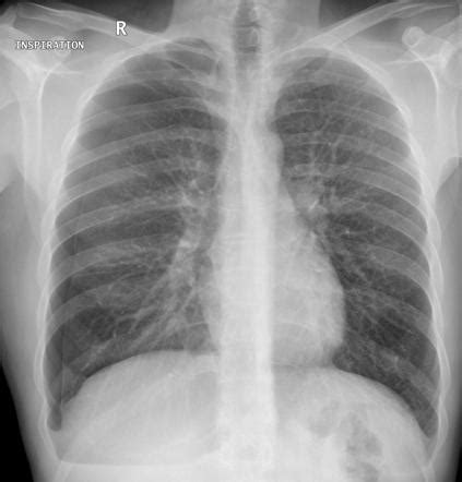 Symptomatic Pneumothorax Summary Radiology Reference Article