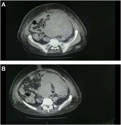 A And B Ct Scan Of The Abdomen And Pelvis Demonstrated A Large Pelvic