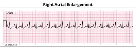 Right Atrial Enlargement Everything You Need To Know