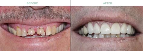 Smile Gallery Dr Sebree And Dr Badall Breez Dental