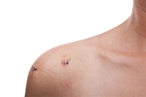 Infections After Shoulder Surgery