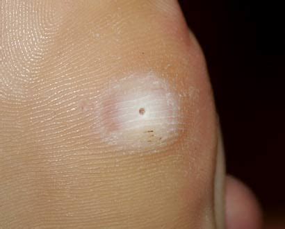 Most people today who obtain an more than the counter wart remover use it for a few of weeks and when they do not see speedy benefits they stop treating it. Plantar Warts