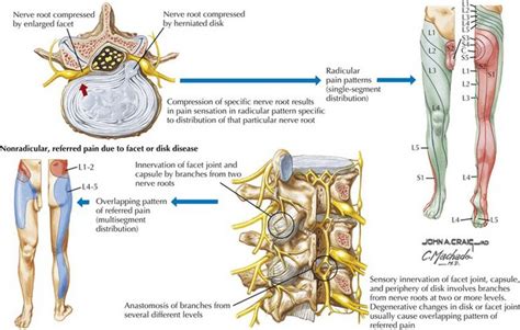 Lumbar Nerve Root Patterns