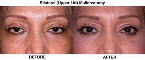 We did not find results for: Upper Eyelid Blepharoplasty/Ptosis REpair | Empire Eye and Laser Center