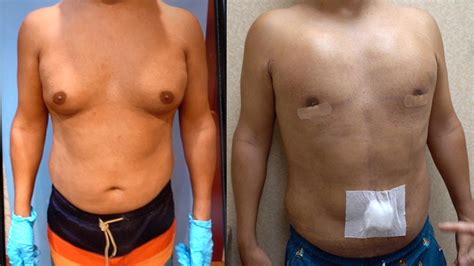 Gynecomastia Surgery 48 Hrs Post Op On Male From California Youtube