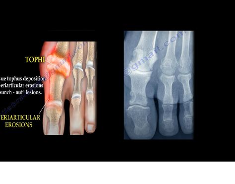 Gout And Hyperuricemia —