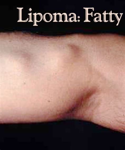 Albums 98 Wallpaper A Lipoma Is A Tumor Composed Of Latest 102023