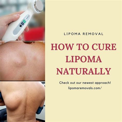 Natural Home Treatment For Lipoma Want Lipoma Treatment At Flickr