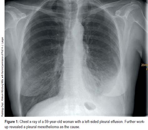 Pleural Effusion In Adults—etiology Diagnosis And Treatment 24052019