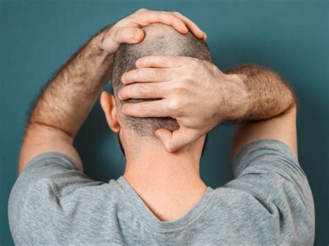 Baldness Ruled Sex Harassment By British Tribunal Toronto Sun