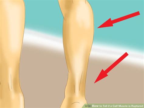 Pet And Animal How To Tell If A Calf Muscle Is Ruptured