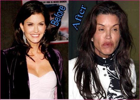 top 25 celebrities before and after plastic surgery and nose jobs bad celebrity plastic