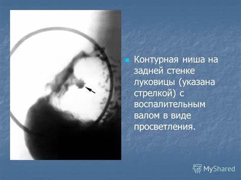 Диета при язве желудка привратника
