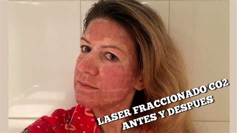 Laser Fraccionado Co2 Antes Y Despues Redsail Laser