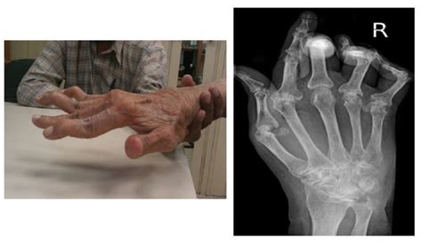 Dolor En Las Articulaciones Sospecha De Artritis Reumatoide
