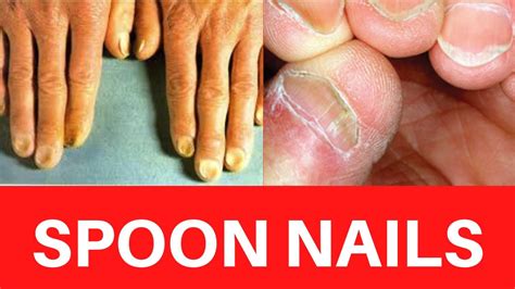 Spoon Nails Koilonychia Causes Treatment Symptoms Iron Deficiency