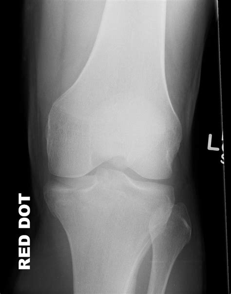 Multiligament Knee Injuries With Associated Tibial Plateau Kulturaupice