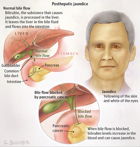 Jaundice Hyperbilirubinemia In Cancer Gastrointestinal Cancer